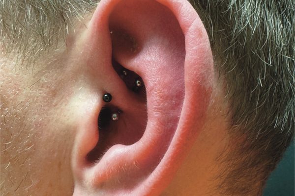 Migräne Piercing Günzburg